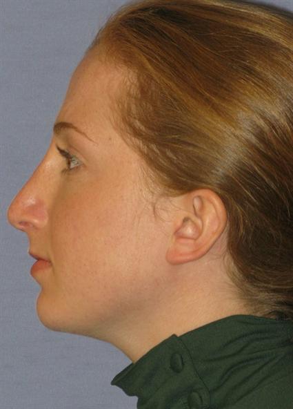 Rhinoplasty Before & After Patient #1719