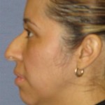 Rhinoplasty Before & After Patient #1714