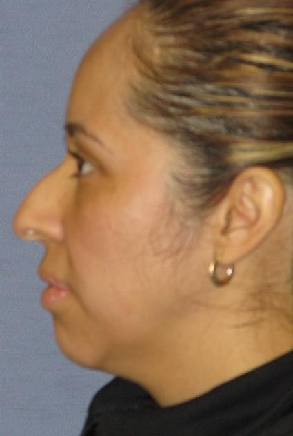 Rhinoplasty Before & After Patient #1714