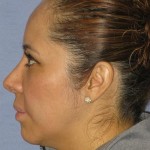 Rhinoplasty Before & After Patient #1714