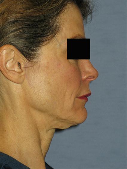 Venus Legacy Before & After Patient #1823