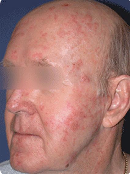 Laser Skin Resurfacing Before & After Patient #1808