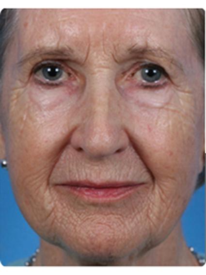 Laser Skin Resurfacing Before & After Patient #1805
