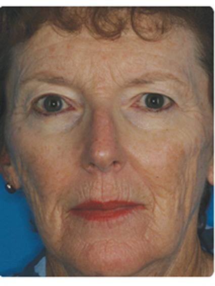 Laser Skin Resurfacing Before & After Patient #1802
