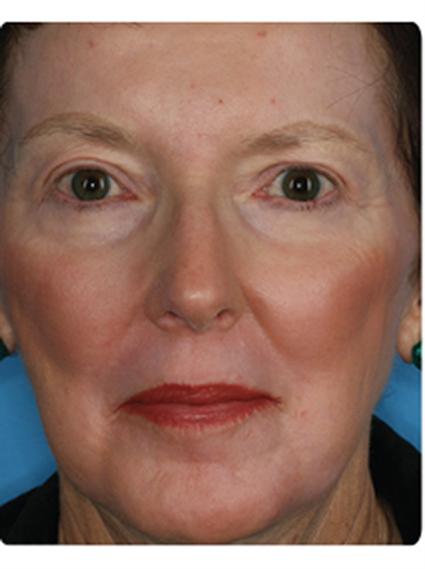 Laser Skin Resurfacing Before & After Patient #1802