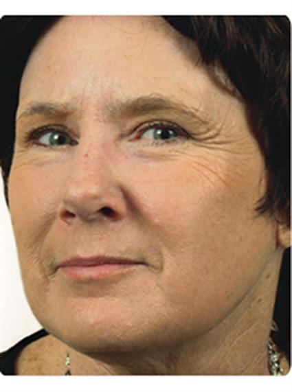 Laser Skin Resurfacing Before & After Patient #1799