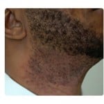 Laser Hair Removal Before & After Patient #1784