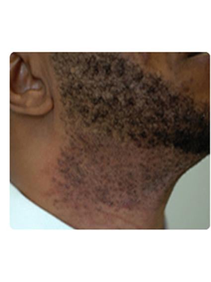 Laser Hair Removal Before & After Patient #1784