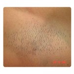 Laser Hair Removal Before & After Patient #1781
