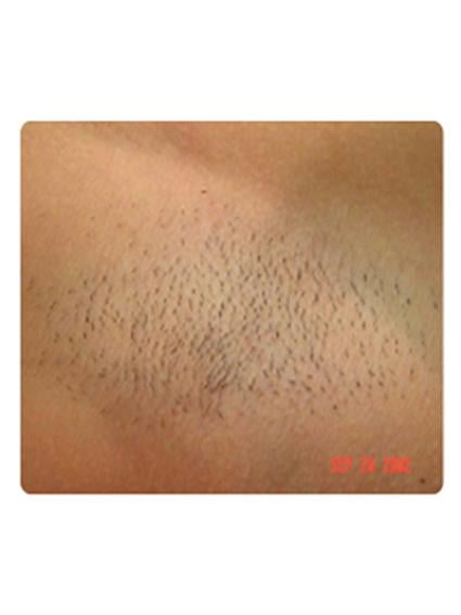 Laser Hair Removal in San Francisco & Marin County