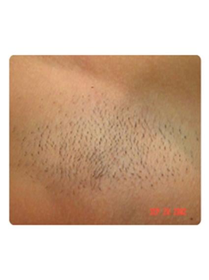 Laser Hair Removal Before & After Patient #1781