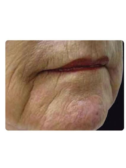 Laser Skin Resurfacing Before & After Patient #1796