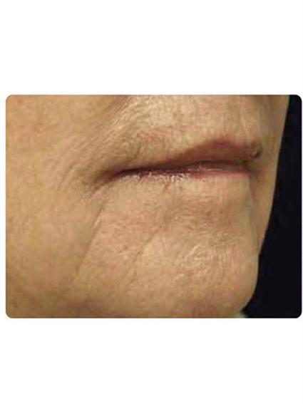 Laser Skin Resurfacing Before & After Patient #1796