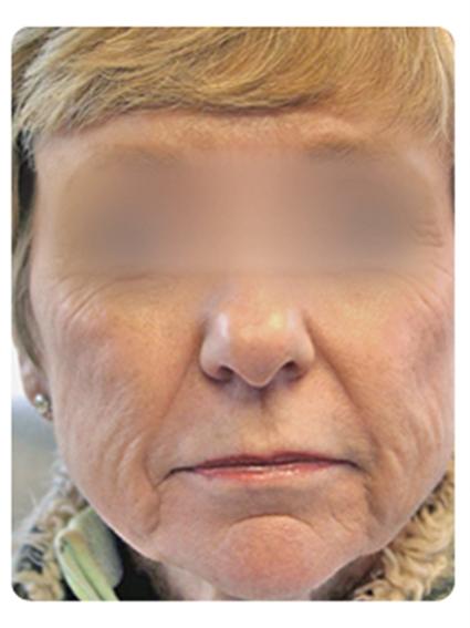 Laser Skin Resurfacing Before & After Patient #1793