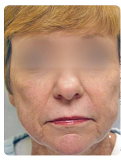 Laser Skin Resurfacing Before & After Patient #1793