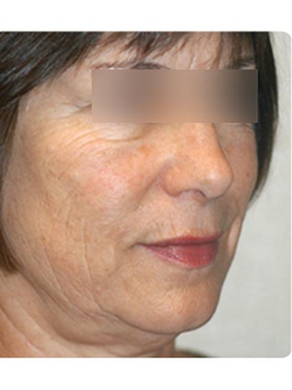 Laser Skin Resurfacing Before & After Patient #1790