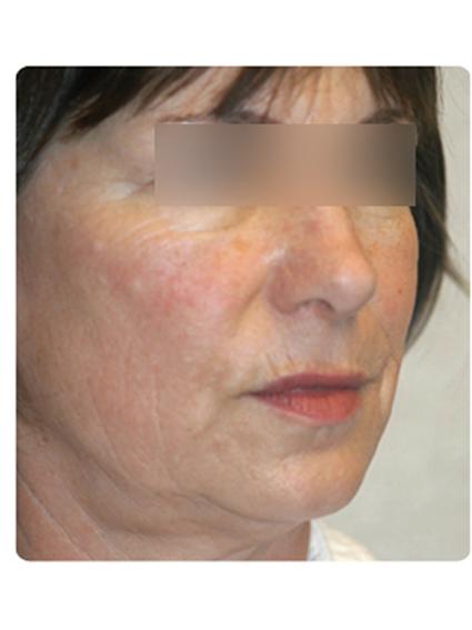 Laser Skin Resurfacing Before & After Patient #1790