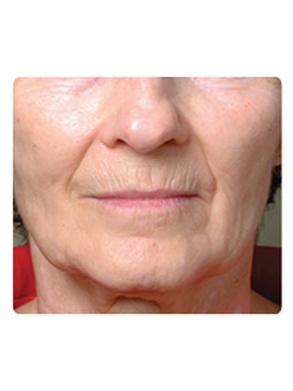 Laser Skin Resurfacing Before & After Patient #1787