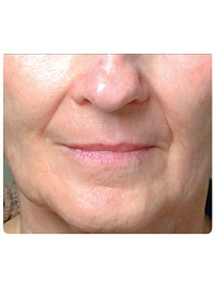 Laser Skin Resurfacing Before & After Patient #1787