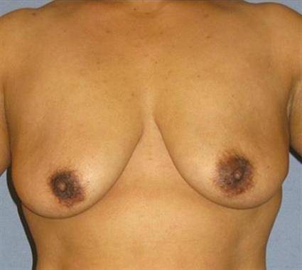 Breast Lift Before & After Patient #1266