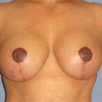 Breast Lift Before & After Patient #1266