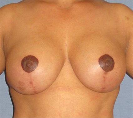 Breast Lift Before & After Patient #1266