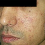 Venus Viva Before & After Patient #1835