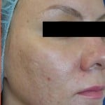 Venus Viva Before & After Patient #1832