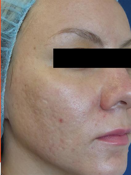 Venus Viva Before & After Patient #1832