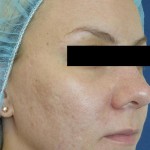 Venus Viva Before & After Patient #1832