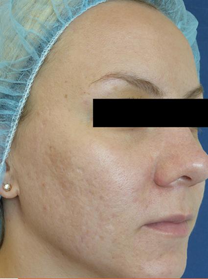 Venus Viva Before & After Patient #1832