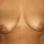Breast Lift Before & After Patient #1263