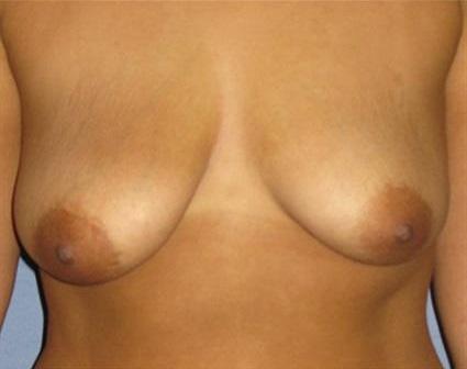 Breast Lift Before & After Patient #1263