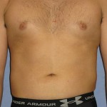 Liposuction Before & After Patient #1043