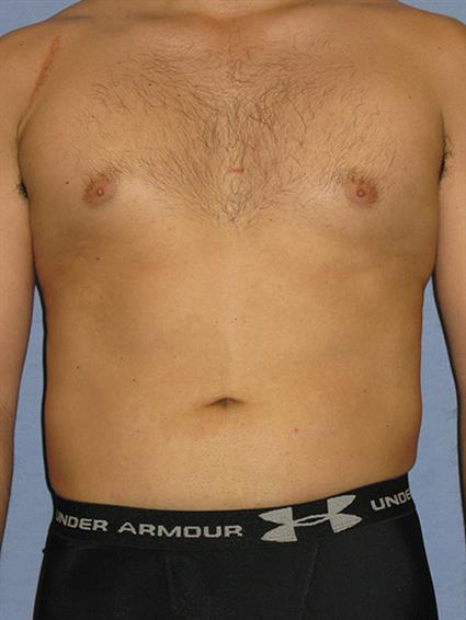 Liposuction Before & After Patient #1043