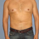 Liposuction Before & After Patient #1043