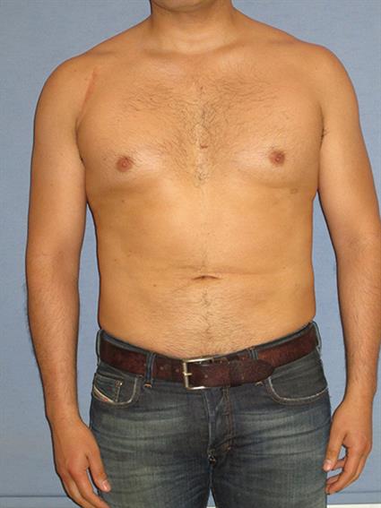 Liposuction Before & After Patient #1043