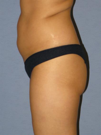 Liposuction Before & After Patient #1040