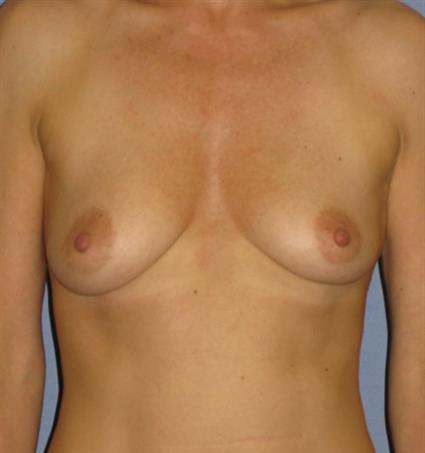 Breast Augmentation Before & After Patient #727