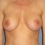 Breast Augmentation Before & After Patient #727