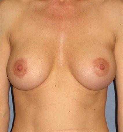 Breast Augmentation Before & After Patient #727