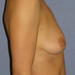 Breast Augmentation Before & After Patient #727