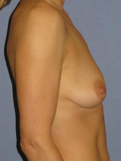 Breast Augmentation Before & After Patient #727