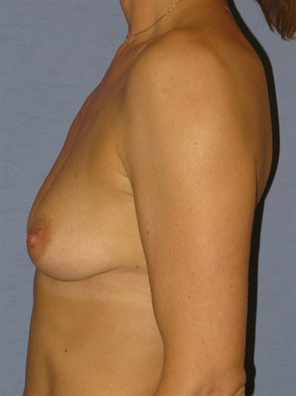 Breast Augmentation Before & After Patient #727