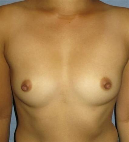 Breast Augmentation Before & After Patient #716