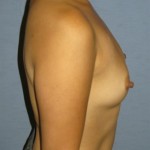 Breast Augmentation Before & After Patient #716