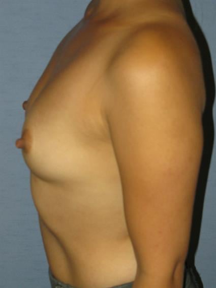 Breast Augmentation Before & After Patient #716