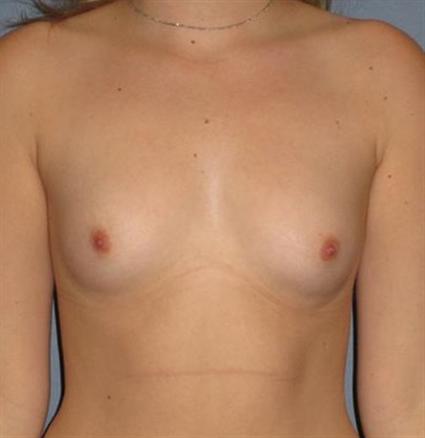 Breast Augmentation Before & After Patient #705