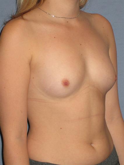 Breast Augmentation Before & After Patient #705