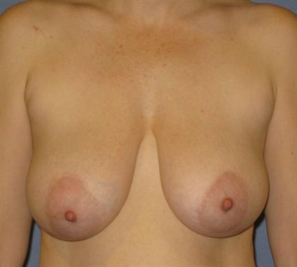 Breast Reduction Before & After Patient #1414